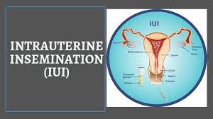 Intrauterine Insemination Treatment